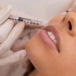 Botox and Facial Fillers